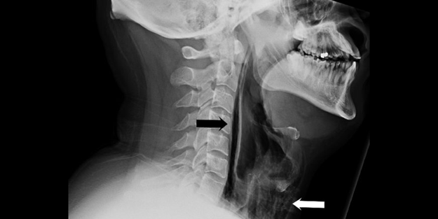 Hapşırırken boğazı yırtıldı