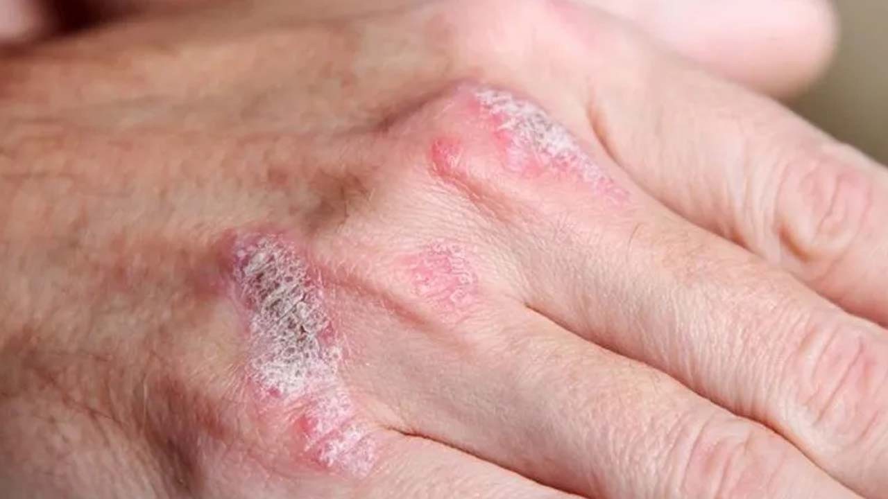 Harvard’dan kritik uyarı verildi! Hiç bilinmeyen bir kronik kaşıntı kanser belirtisi olabilir!