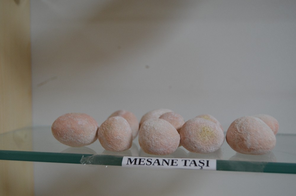 Hastalardan çıkarılan böbrek taşları sergileniyor 