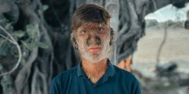 Hastalığı dünyasını altüst etti! 'Kurt Adam'a dönüştü