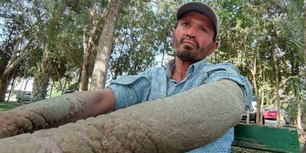 Hastalığı yüzünden insanlar ondan kaçıyor