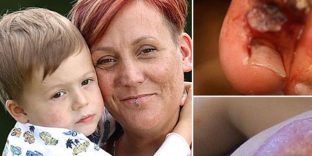 Hastalığı yüzünden tırnakları dökülüyor