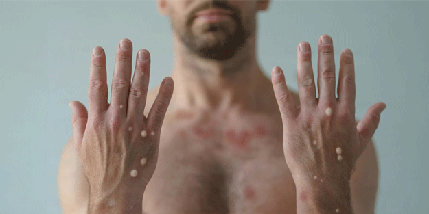 Hastalıkla alakalı merak edilenler yayınlandı! Sağlık Bakanlığı’ndan maymun çiçeği rehberi