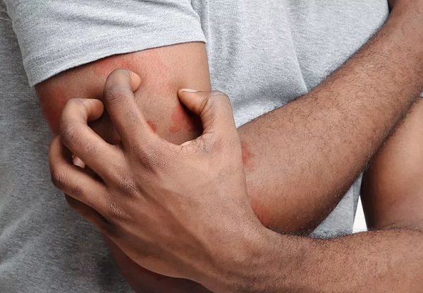 Hayalet hastalık yaz mevsiminde artıyor! 300 hastalığı taklit ediyor