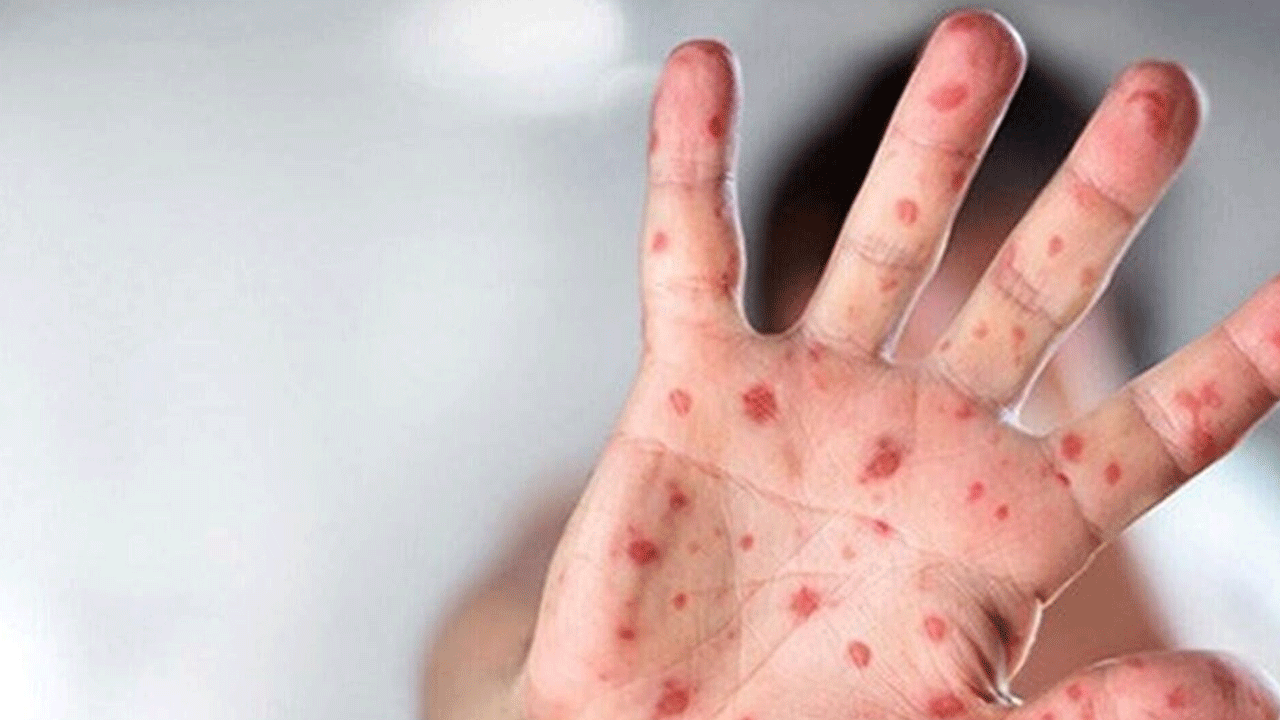 Hem hayvanlardan hem de insanlardan bulaşıyor! 4 kişide M çiçeği vakası tespit edildi