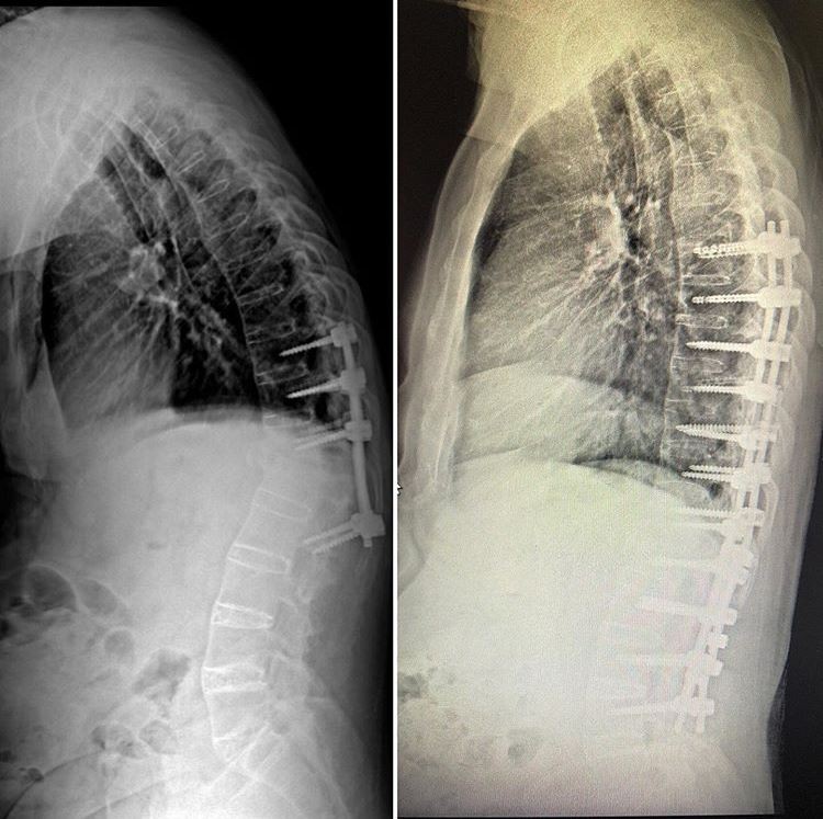 Hem kamburluğu giderildi hem de sağlığına kavuştu 