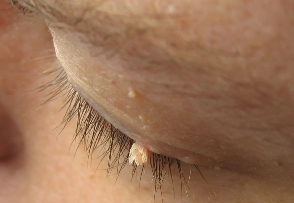 Hem kolay hem etkili! Bu yöntemle siğilleriniz hızla kaybolacak