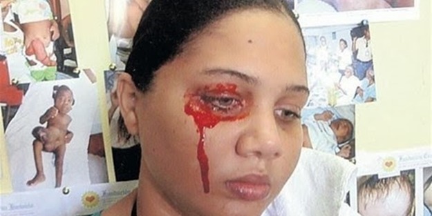 Hematidrosis nedir? Tedavisi nelerdir?