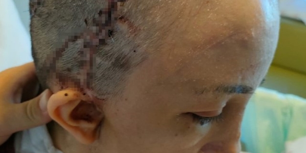 Hemşirenin kafatası ameliyatta kayboldu