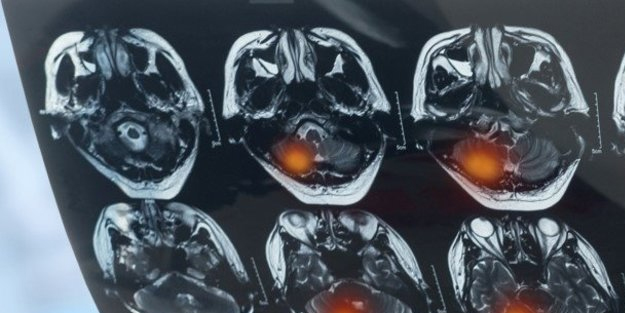 Hepimiz bilmeden her gün tüketiyoruz ancak beyni küçültüyor! Sık sık tüketenlere kötü haber: Bu test beyin yakıyor