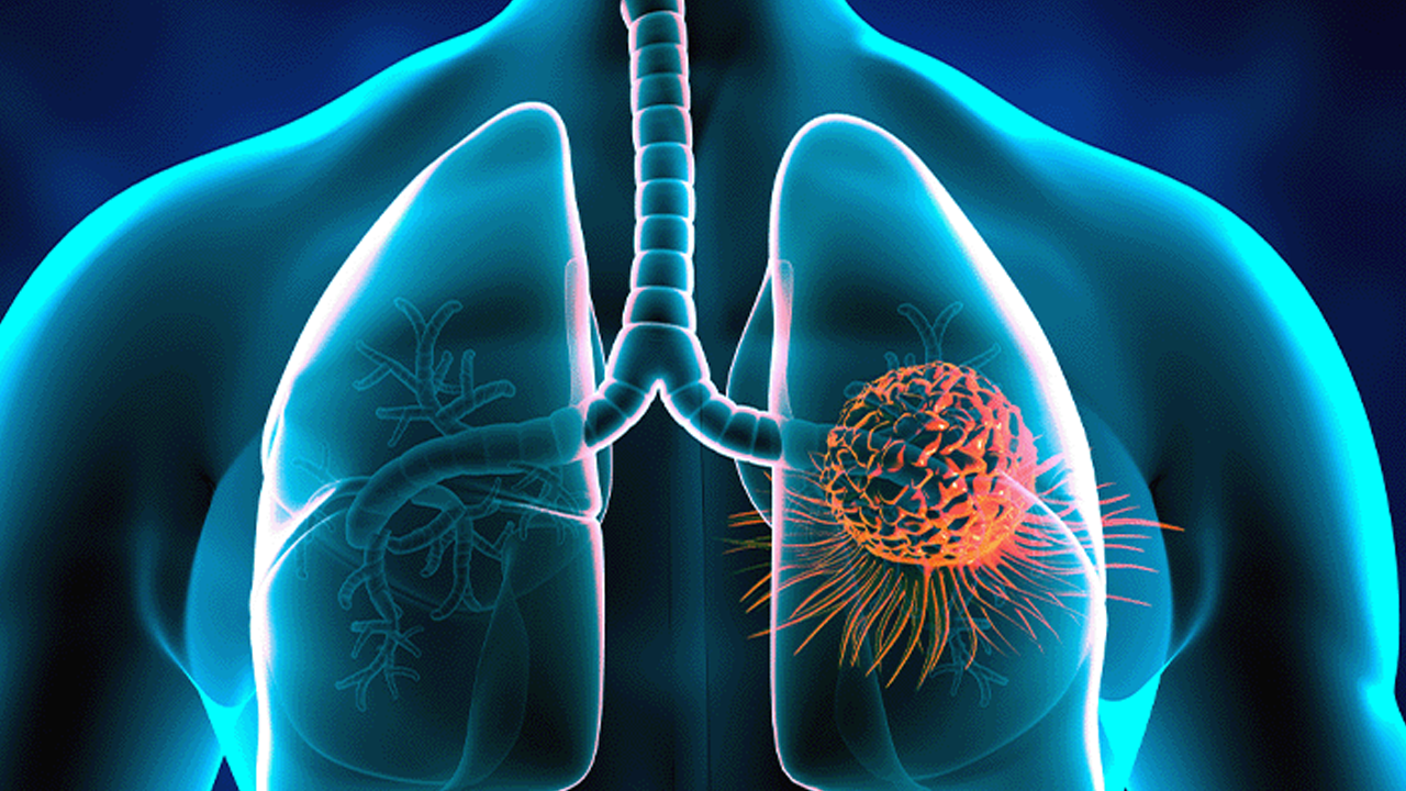 Her 10 kişiden biri KOAH hastası! Akciğer kanseri ile sonuçlanıyor!