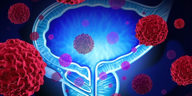 Her 4 dakikada 1 erkek bu hastalıkla tanışıyor... Prostat kanserine karşı 6 öneri
