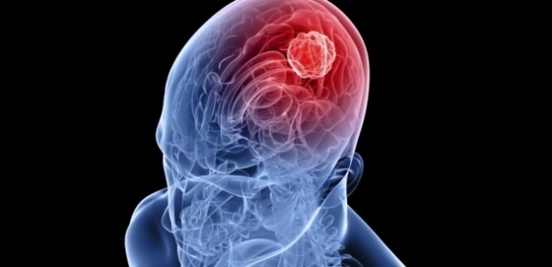 Her beyin tümörü hayatı tehdit etmiyor