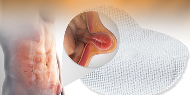 Her yıl yüz binlerce kişi yakalanıyor! Bel fıtığında yeni dönem