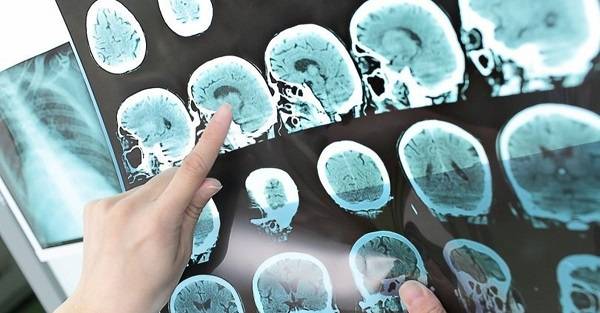 Hidrosefali hastalığı nedir? Hidrosefali hastalığı belirtileri neler?