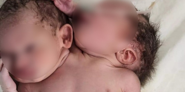 Hindistan'da çift başlı bebek görenleri şaşırttı