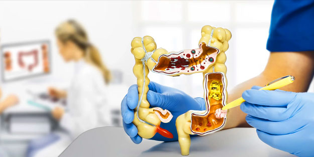 Hızla artan bağırsak kanserini basit önlemlerle engelleyebilirsiniz