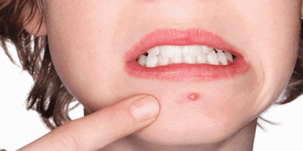 Hormonal sivilce tedavileri nelerdir?