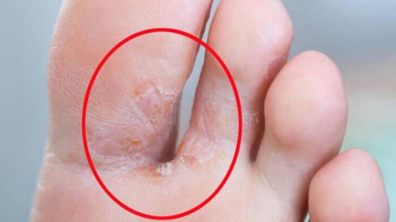 İbrahim Saraçoğlu tırnak mantarı bitkisel tedavisi: Bu yöntemle 3 günde kurtulun!