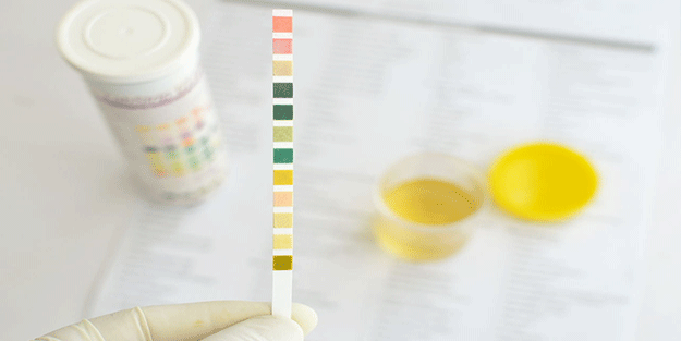 İdrar renginiz böbrek sağlığınız hakkında bilgi veriyor