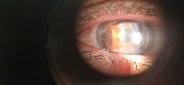 İki yıldır çekiyor! Uçuk deyip geçmeyin hayatı kabusa döndü