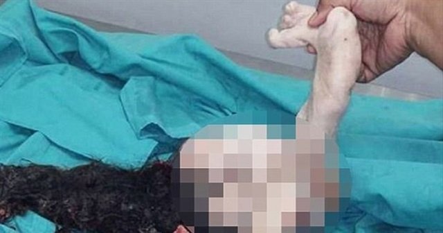 İkizinin midesinden tam 15 yıl sonra çıktı