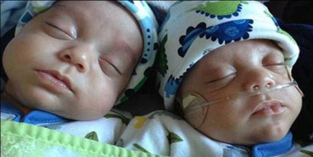 İkizlerden biri 39 gün sonra doğdu