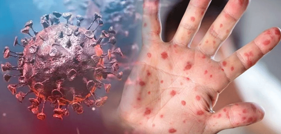 İl Sağlık Müdürlüğü açıkladı: Ankara’da maymun çiçeği vakası var mı?