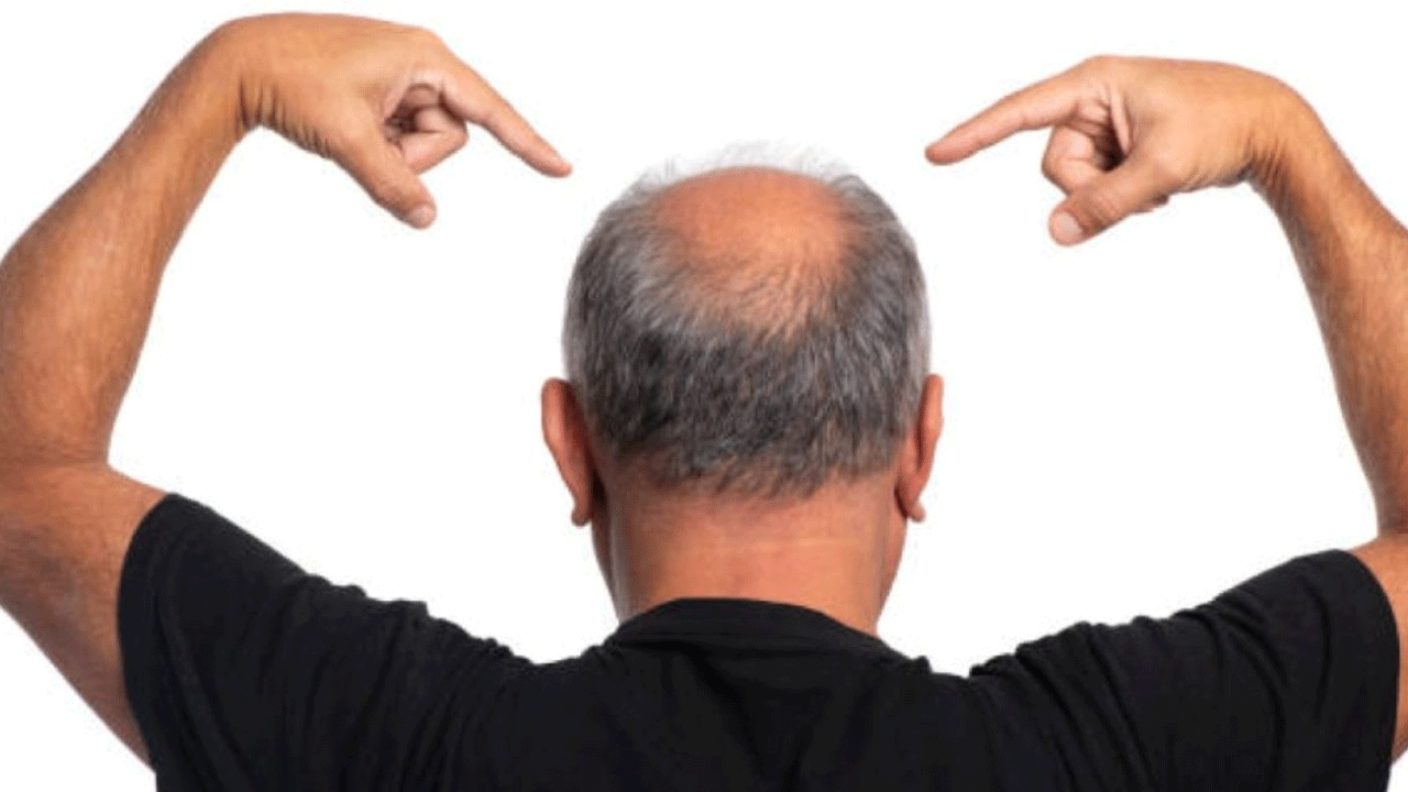 İlacı bulundu! Kellik artık tarihe karışıyor