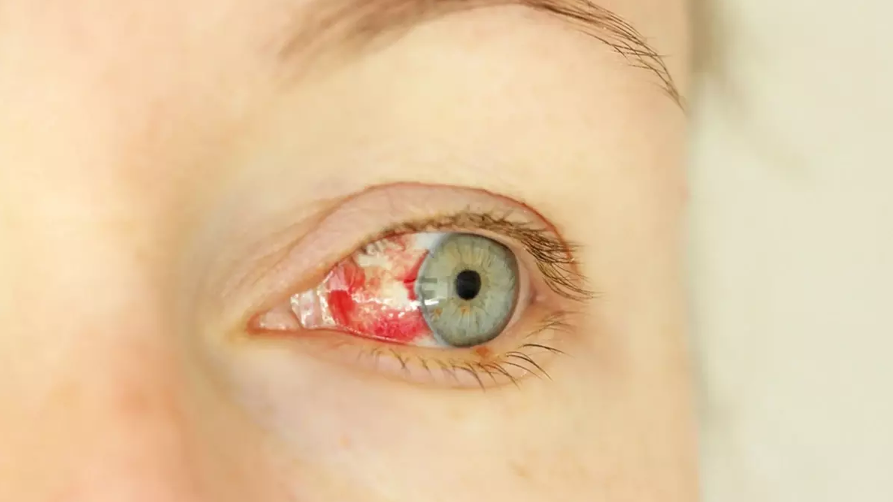 İlk belirtisi gözde kanama: Gizemli salgın 8 can aldı!