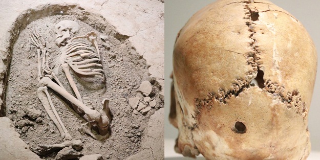 İlk beyin ameliyatı 11 bin yıl önce Aksaray'da yapılmış