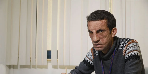 İlk yüz naklini yaptıran Türk şimdi bakın ne yapıyor