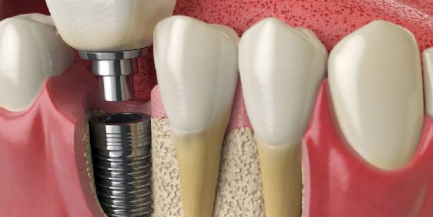 İmplant diş çekimi yapacaklar dikkat!