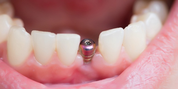 İmplant yaptırdı, çenesi eridi!