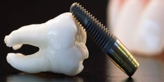 İmplatın yararları nelerdir? İşte tüm detaylarıyla implant...