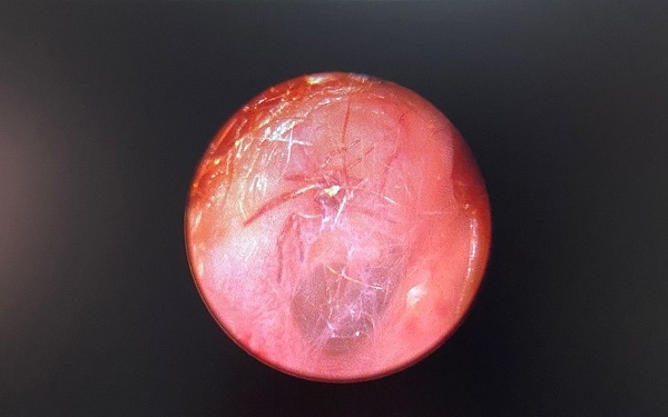 İnanılır gibi değil! Bakın yaşlı kadının kulağından ne çıktı