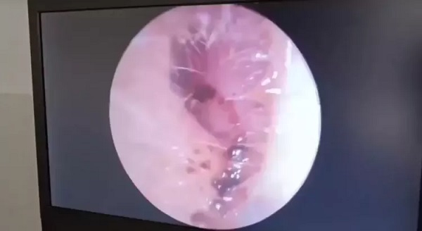 İnanılır gibi değil | Kadının kulağından öyle bir şey çıktı ki!