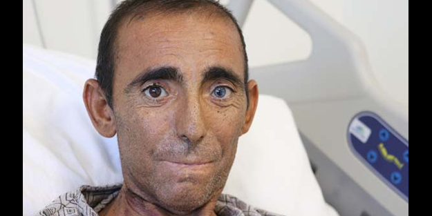 İnanılmaz hikaye! Beşinci böbreğini karnında taşıyor