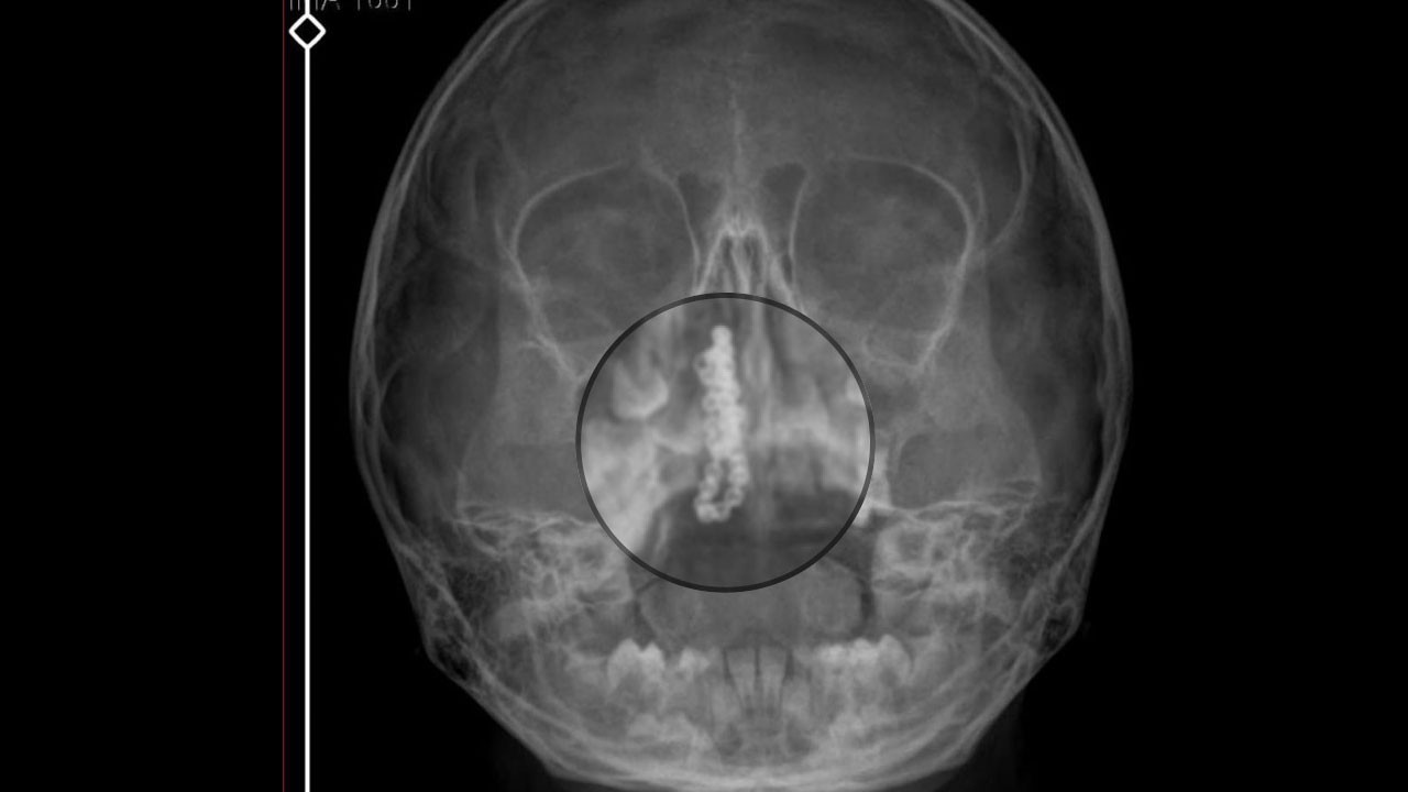 İnanması güç ama 2 sene böyle yaşadı! Küçük kızın burnundan çıkana inanamayacaksınız
