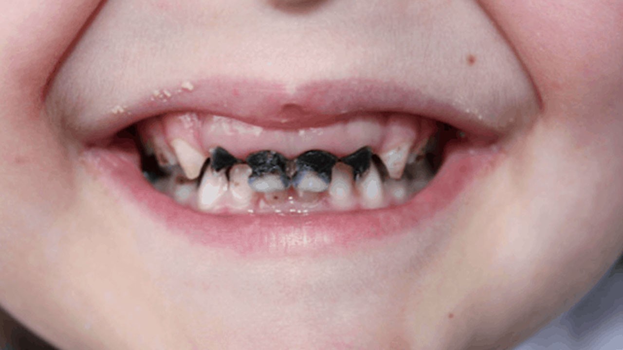 Çürüyen süt dişleri çene yapısını kötü etkileyebilir