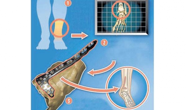 İngiltere’de kırılan kemiğe 3D onarım