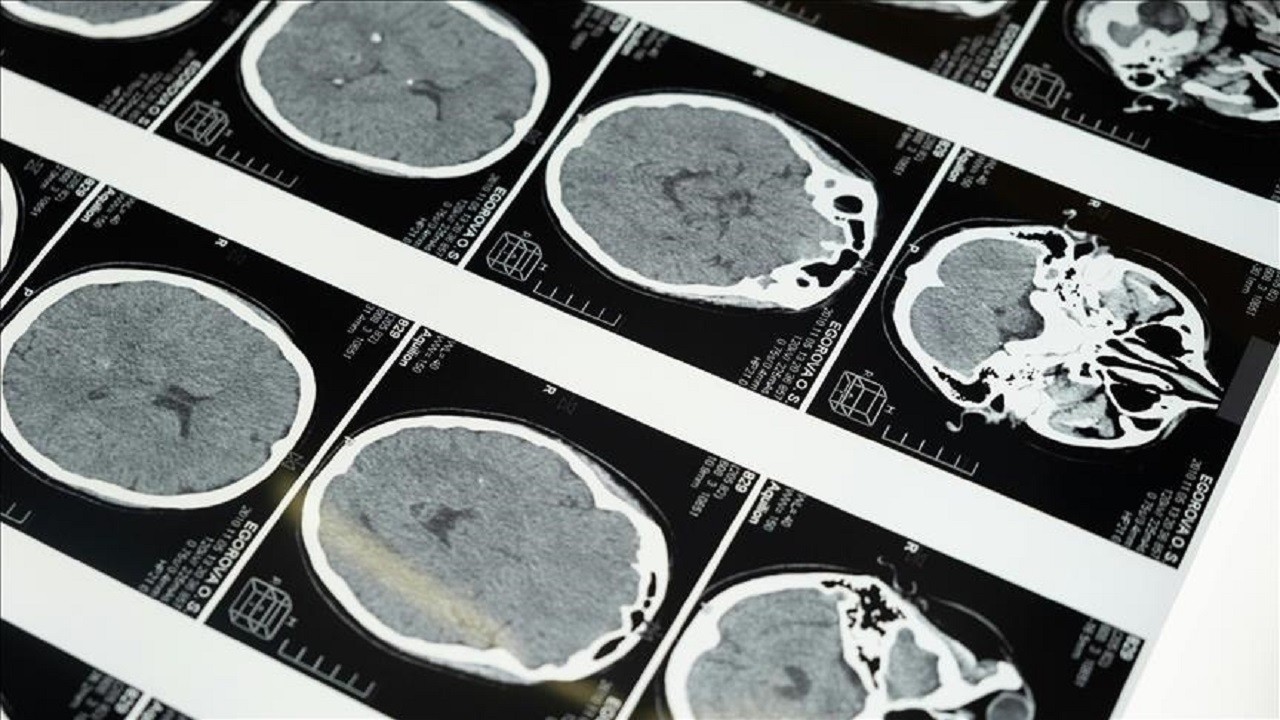 İnme tedavisinde yapay zeka devrimi!