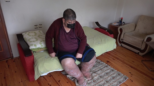 İnsan içine çıkamıyordu! Sivrisinek ısırığı hayatından etti!