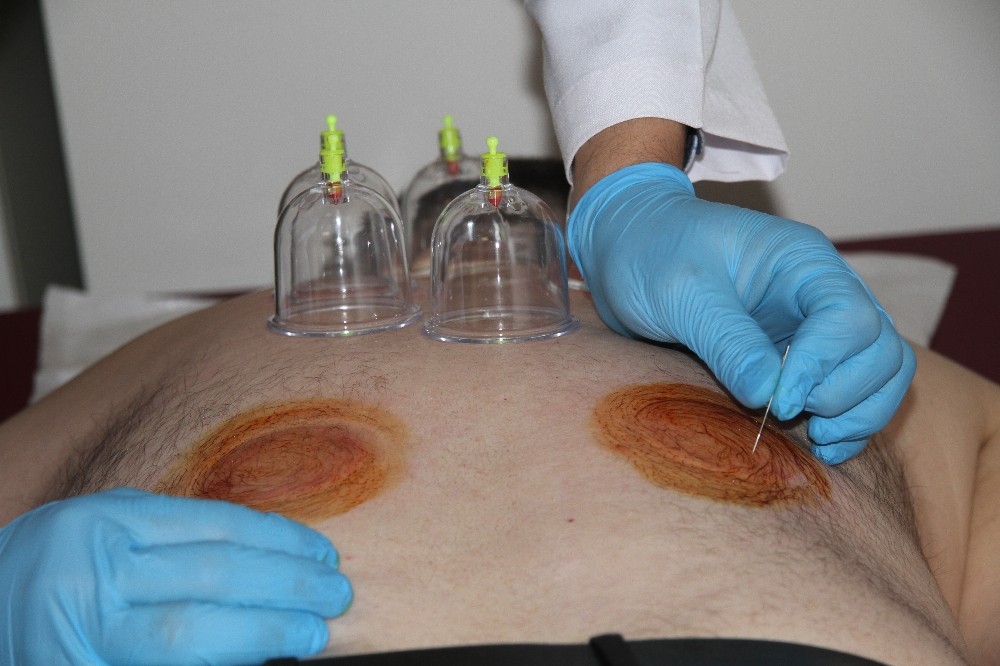 Isparta Şehir Hastanesi’nde kupa ve hacamat tedavisi dönemi 