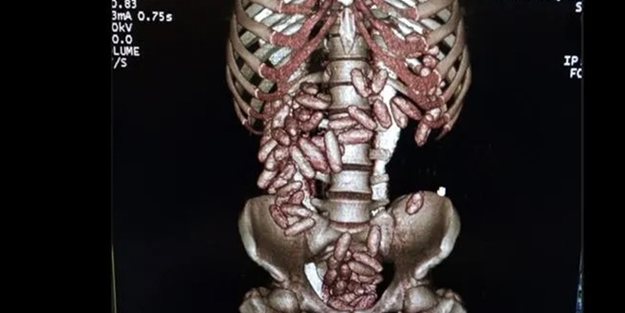 İstanbul Havalimanı'nda bir kişinin midesinde onlarca paket...