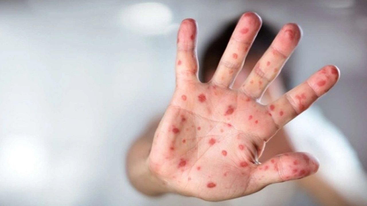 İstanbul'da kızamık alarmı!