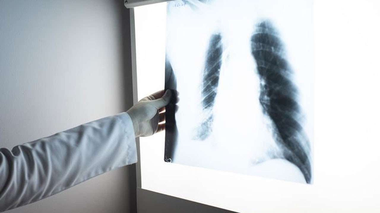 İşte akciğer kanserinden korunmanın yolları