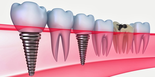 İşte diş implantı hakkında bilinmeyenler