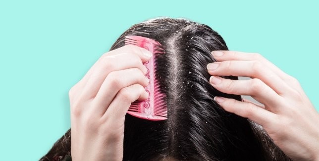 İşte, kepek sorunundan hızlıca kurtulmanın 8 yöntemi