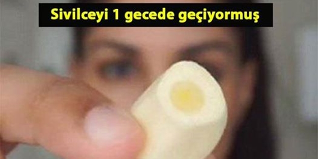 İşte sivilcelerden kurtulmanın yolu!